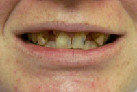 before and after pictures of teeth whitening