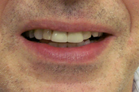picture of crowns and veneers