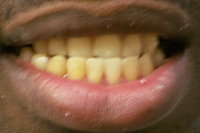 pictures of dentures