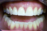 pictures of whitening and bonding